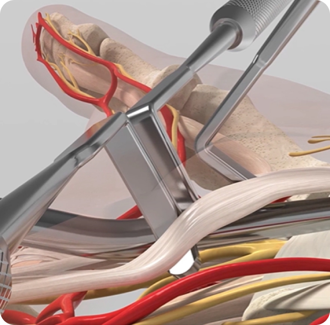 Revolutionizing Surgical Precision